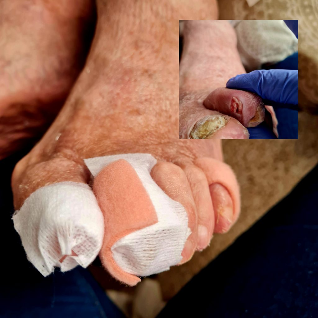 Collage de fotografías de tratamientos de pie diabético realizados en 21 Pasos.